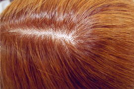 直毛変換　ビフォーアフター|HAIR COMMUNITY DEAR