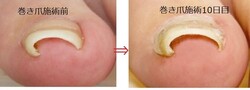 痛い巻き爪