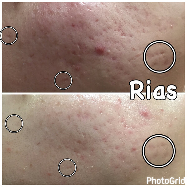 【凸凹・クレーター】ハーバルピール|Rias