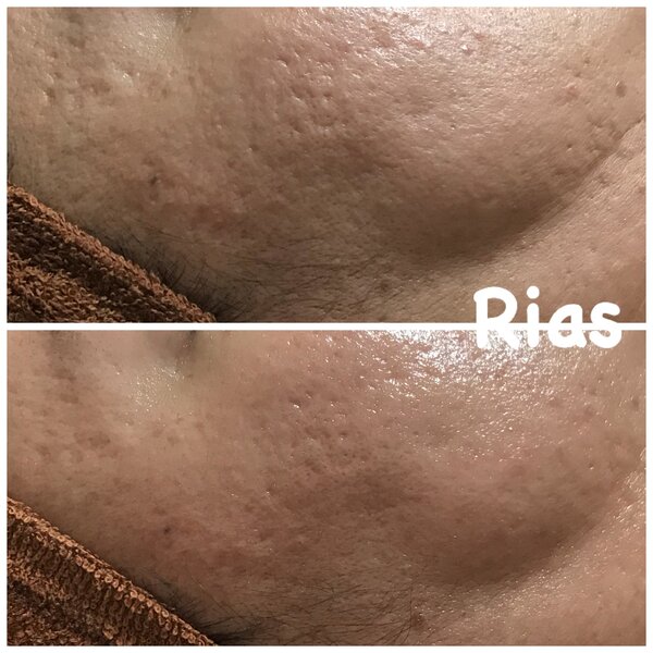 【凸凹・クレーター】ハーバルピール|Rias