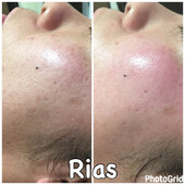 【しみ・くすみ・シワ】ハーバルピール|Rias