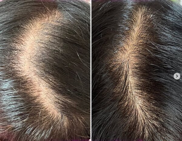 《髪のお悩み》薄い細い少ない髪プロセルセラピーズ★|美・キュート