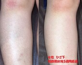 【女性】ひざ下脱毛|脱毛サロン　NIKA
