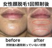 【女性】顔脱毛|脱毛サロン　NIKA