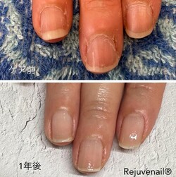 自爪育成★1年後|Rejuvenail Total Produce