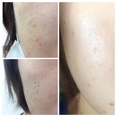 本気のシミケア★経過|PSエステ　富田林金剛店