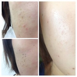 本気のシミケア★経過|PSエステ　富田林金剛店