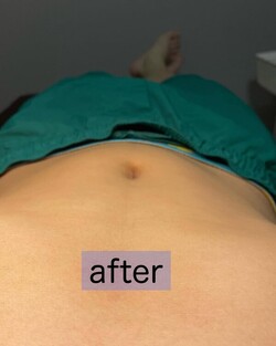 お腹脱毛|癒しと脱毛サロン trillium