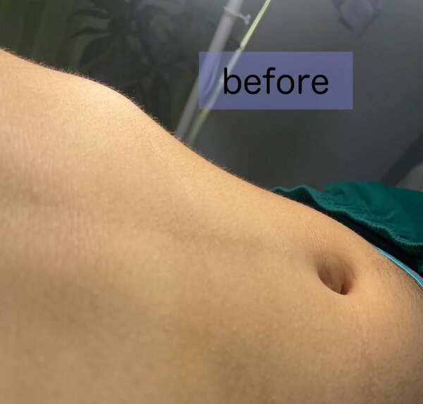 お腹脱毛|癒しと脱毛サロン trillium