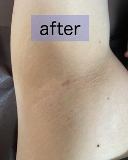 脇脱毛|癒しと脱毛サロン trillium