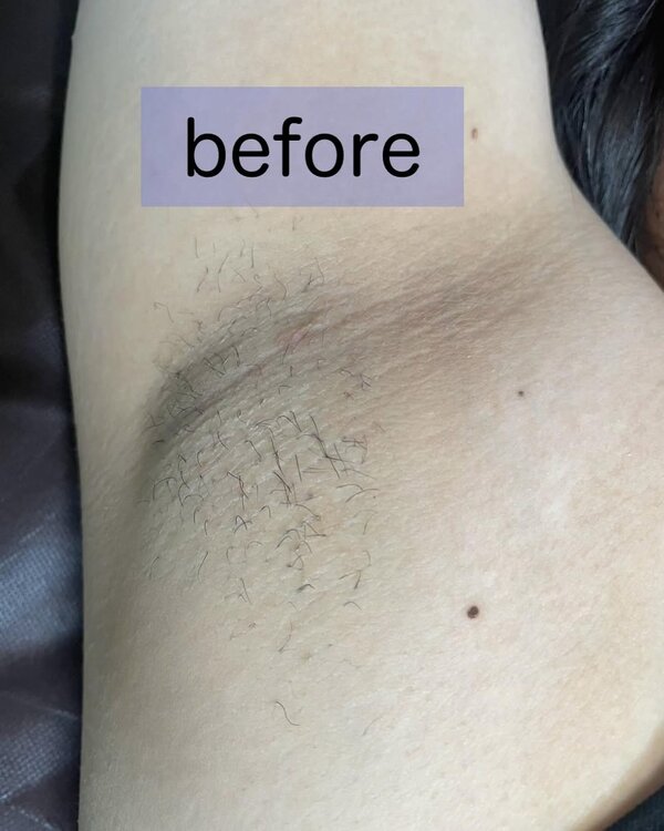 脇脱毛|癒しと脱毛サロン trillium