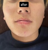 ひげ脱毛|癒しと脱毛サロン trillium