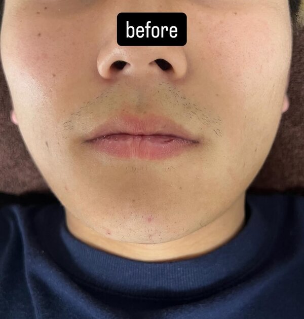 ひげ脱毛|癒しと脱毛サロン trillium