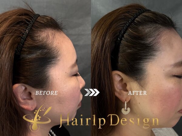 【ヘアライン】Ｍサイズ③|グランモア代々木店