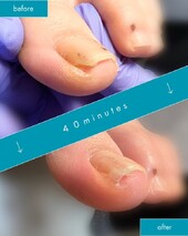 皮膚科でよくならなかった陥入爪|巻き爪ケア Tawa