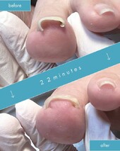 市販の補正器具で改善できなかった巻き爪|巻き爪ケア Tawa