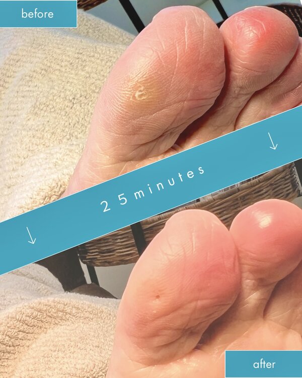 ５年前から痛い魚の目|巻き爪ケア Tawa