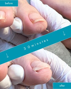 時々膿んでしまう陥入爪|巻き爪ケア Tawa