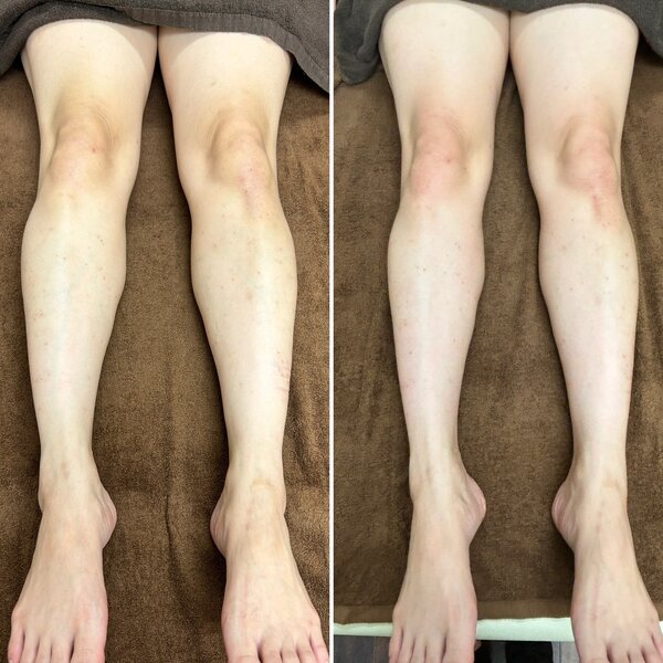 愛式メディカルリンパ　脚|愛式メディカルリンパ　Calluna