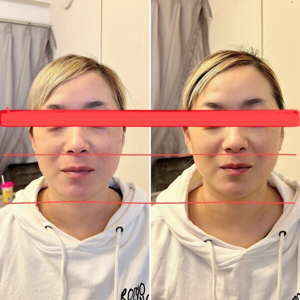 愛式メディカルリンパ　顔|愛式メディカルリンパ　Calluna