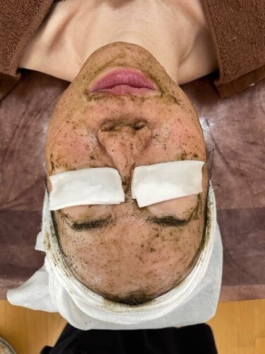 ハーブピーリング