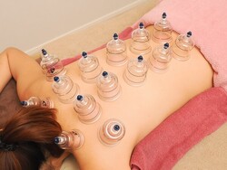 吸い玉（カッピング）|SA’S はりきゅうサロン