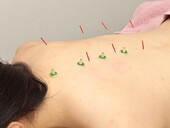 お灸|SA’S はりきゅうサロン