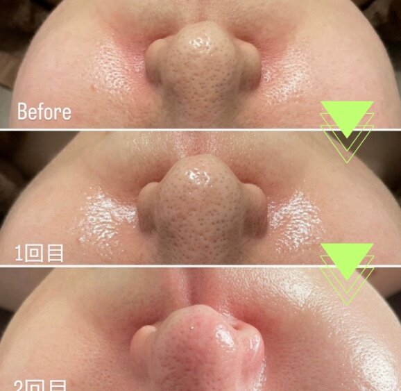 ラミネーションピール|Kalon