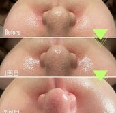 ラミネーションピール|Kalon