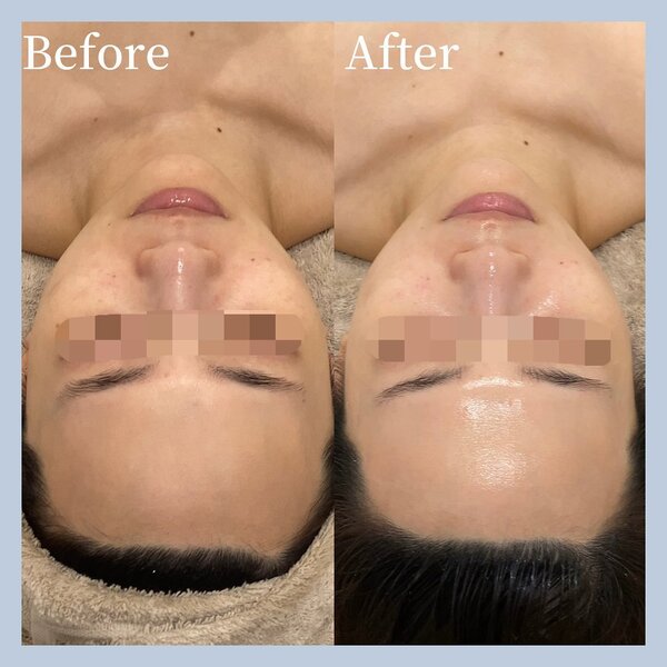 フェイスハーブピーリング|aimer more 国立店