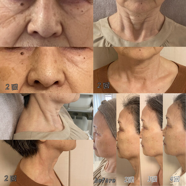 リフェイス-reface-|Kalon