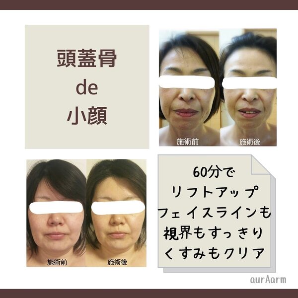 頭蓋骨de小顔【ビフォーアフター】|エステサロン aurAarm