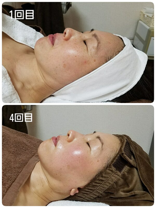 ハーブピーリング　アマービレ|sayaPadoma