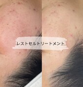 レストセルトリートメント|スマイルサロン