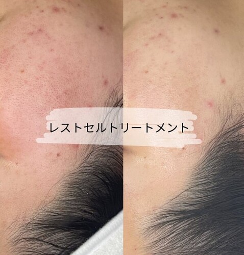 レストセルトリートメント