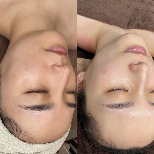 マーメイドセルトリートメント