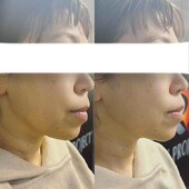 高速小顔Vフェイス*サーマリフト|医療提携サロンYAE C5 CLINIC