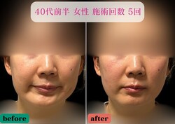 【エラ張り強制終了】エラ特化美容鍼+小顔LED+顔幅矯正|美容とカラダの鍼灸サロン やなけん 亀戸店