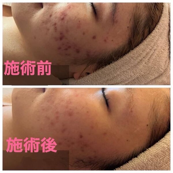 【ハイドラフェイシャル】ビフォーアフター①|Beauty Salon Remiha