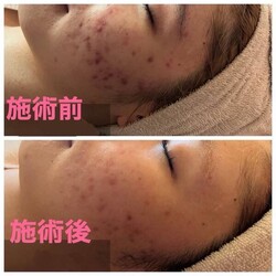 【ハイドラフェイシャル】ビフォーアフター①|Beauty Salon Remiha