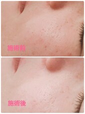 【ハイドラフェイシャル】ビフォーアフター②|Beauty Salon Remiha