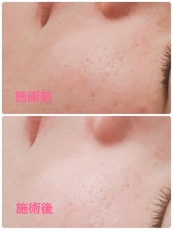 【ハイドラフェイシャル】ビフォーアフター②|Beauty Salon Remiha