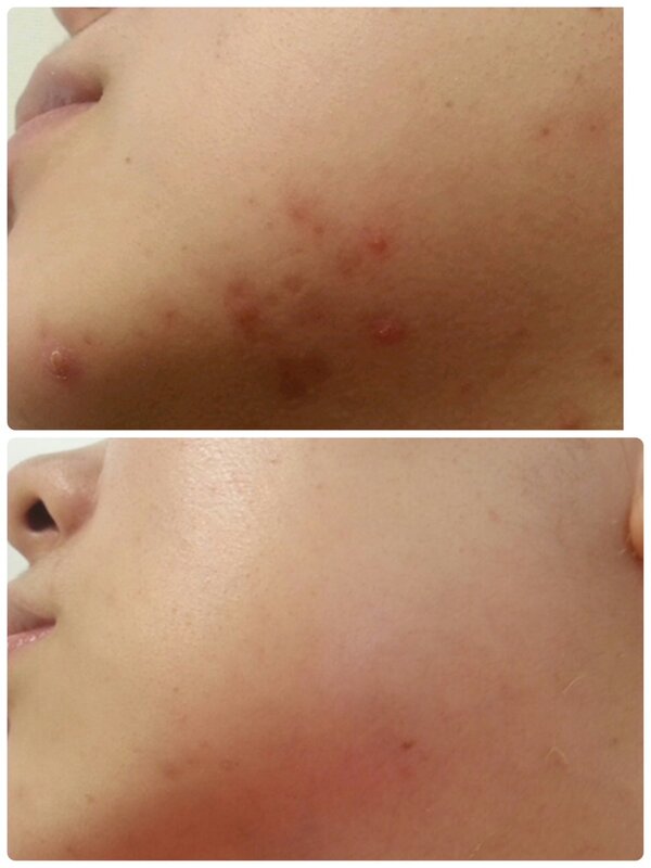 【ハイドラフェイシャル】ビフォーアフター③|Beauty Salon Remiha