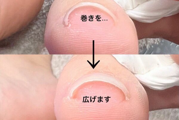 「巻き爪や生えグセを根本から改善していくメニュー」|Nail Salon Linda