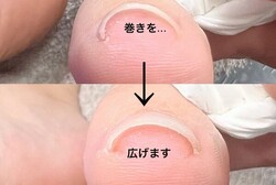 「巻き爪や生えグセを根本から改善していくメニュー」|Nail Salon Linda