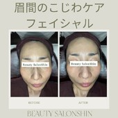  【フェイシャル】ビフォーアフター①|ビューティーサロンshin