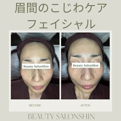  【フェイシャル】ビフォーアフター①|ビューティーサロンshin