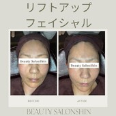  【フェイシャル】ビフォーアフター②|ビューティーサロンshin