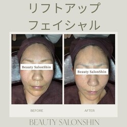  【フェイシャル】ビフォーアフター②|ビューティーサロンshin