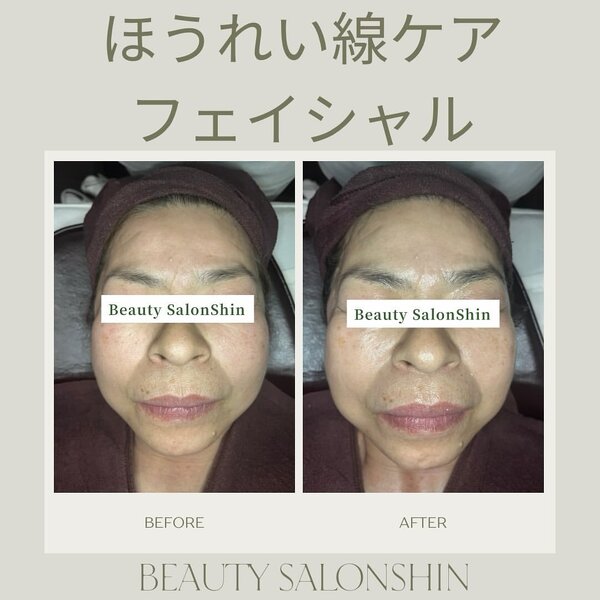  【フェイシャル】ビフォーアフター③|ビューティーサロンshin